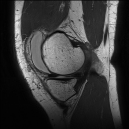 Anterior cruciate ligament rupture with Segond fracture (Radiopaedia 69043-78806 Sagittal PD 50).jpg