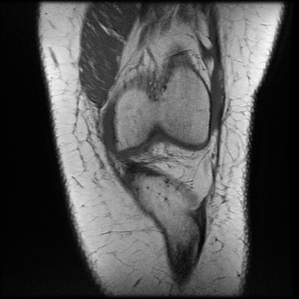 File:Anterior cruciate ligament tear, Wrisberg rip and bucket-handle tear of medial meniscus (Radiopaedia 75872-87266 Coronal T1 9).jpg
