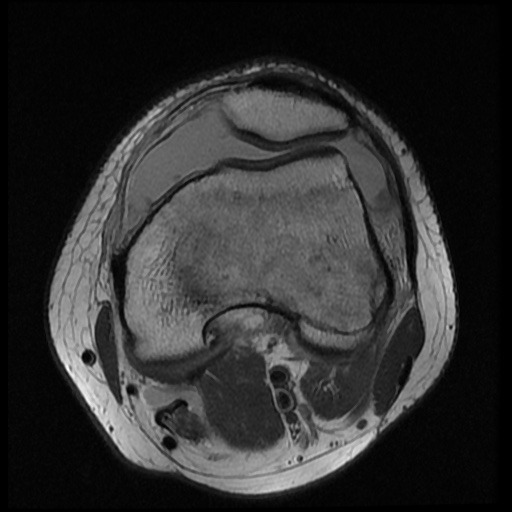 File:Anterior cruciate ligament tear (Radiopaedia 61500-69462 Axial PD 7).jpg
