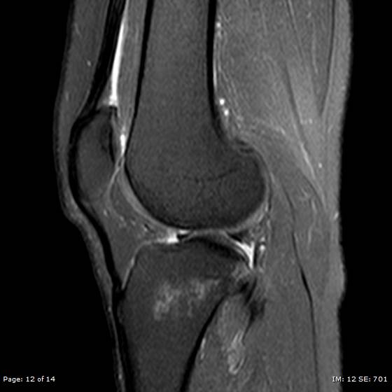 File:Anterior cruciate ligament tear (Radiopaedia 70783-80964 Sagittal PD fat sat 12).jpg
