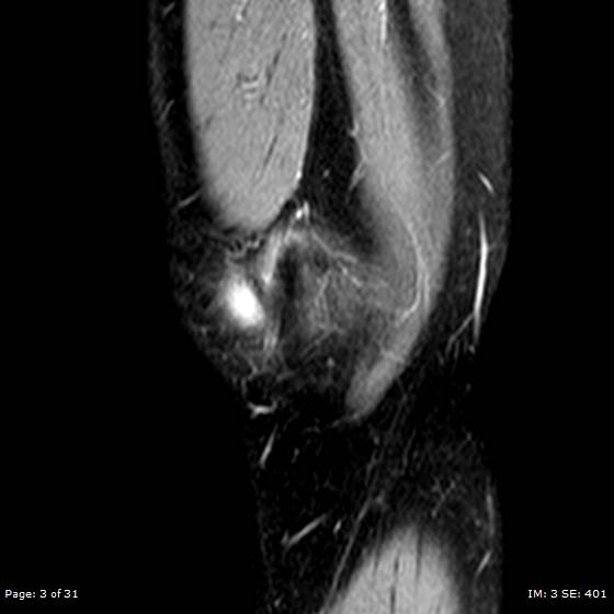File:Anterior cruciate ligament tear (Radiopaedia 70783-80964 Sagittal STIR 3).jpg