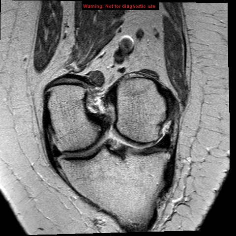 File:Anterior cruciate ligament tear - complete (Radiopaedia 12175-12514 Coronal PD 7).jpg