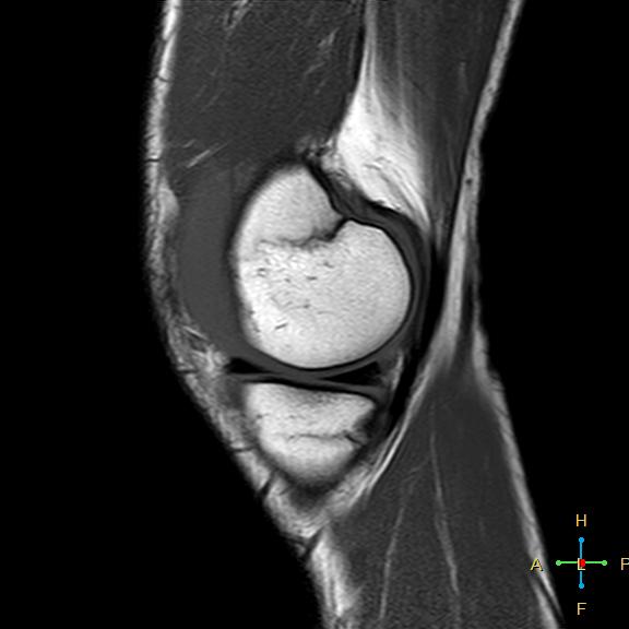 File:Anterior cruciate ligament tear - complete (Radiopaedia 24907-25170 Sagittal T1 15).jpg