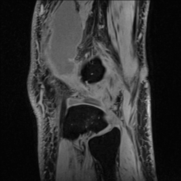 Anterior cruciate ligament tear - ramp lesion (Radiopaedia 71883-82322 Sagittal T1 vibe 24).jpg