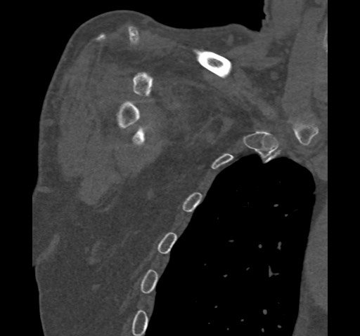 Anterior glenohumeral dislocation with Hill-Sachs lesion (Radiopaedia 62877-71249 Coronal bone window 11).jpg
