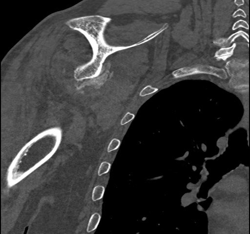 Anterior glenohumeral dislocation with Hill-Sachs lesion (Radiopaedia 62877-71249 Coronal bone window 68).jpg