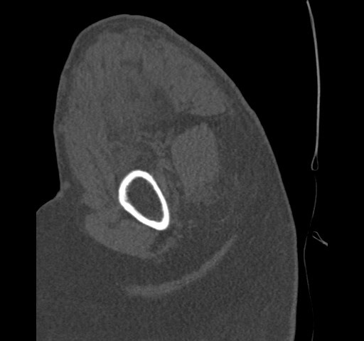 Anterior glenohumeral dislocation with Hill-Sachs lesion (Radiopaedia 62877-71249 Sagittal bone window 18).jpg