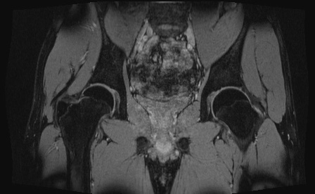 Anterior inferior iliac spine avulsion fracture (Radiopaedia 81312-95000 G 37).jpg