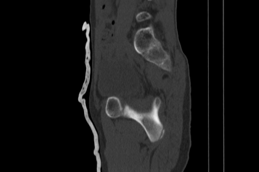 Anterior inferior iliac spine avulsion injury (Radiopaedia 88666-105376 Sagittal bone window 38).jpg