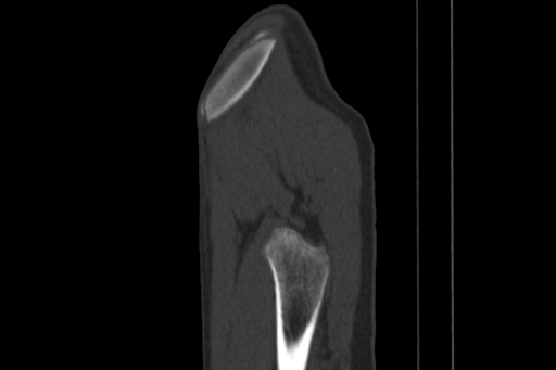 Anterior inferior iliac spine avulsion injury (Radiopaedia 88666-105376 Sagittal bone window 88).jpg