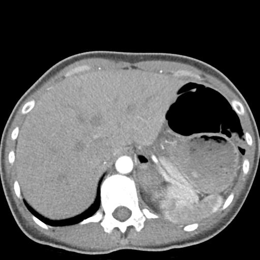 File:Anterior mediastinal lymphoma (Radiopaedia 29556-30061 C 52).jpg