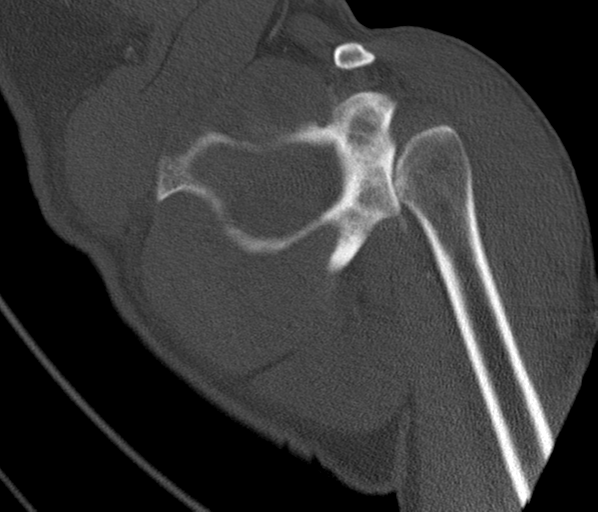 Anterior shoulder dislocation with Hill-Sachs and bony Bankart lesions (Radiopaedia 40424-42974 Coronal bone window 29).png