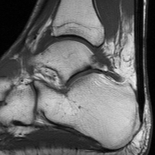 File:Anterior talofibular ligament rupture (Radiopaedia 15831-15484 Sagittal T1 9).jpg