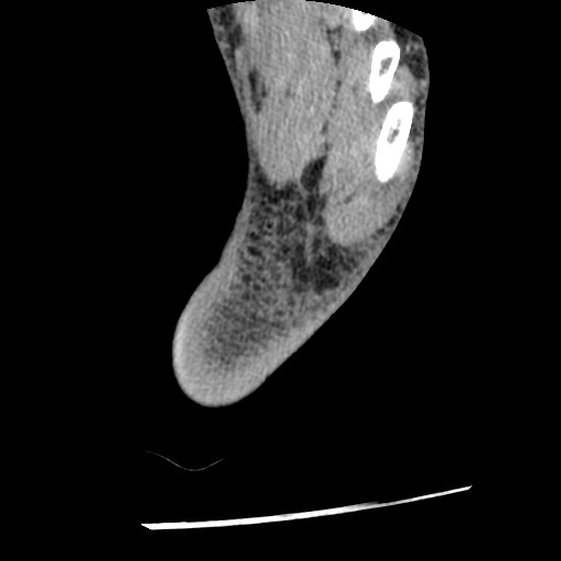 Anterior tibial artery false aneurysm (Radiopaedia 88984-105809 A 252).jpg