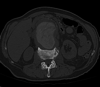 File:Anterior vertebral scalloping (abdominal aortic aneurysm) (Radiopaedia 66744-76067 Axial bone window 10).jpg