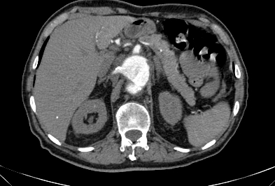 File:Anterior vertebral scalloping (abdominal aortic aneurysm) (Radiopaedia 66744-76067 F 12).jpg
