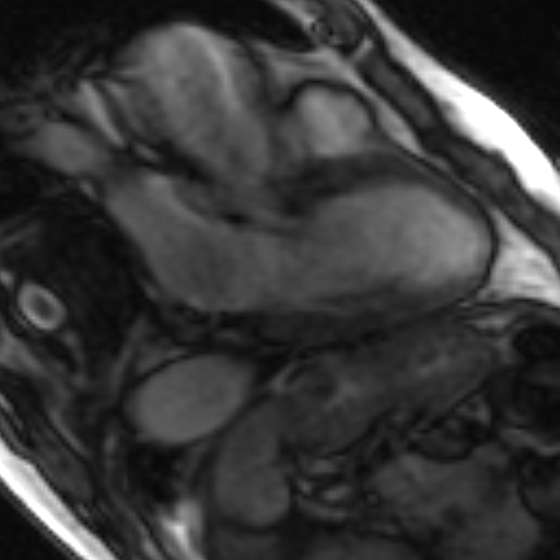 File:Anteroseptal hypokinesia after myocardial infarction (Radiopaedia 15978-15633 3 chamber view SSFE 30).jpg