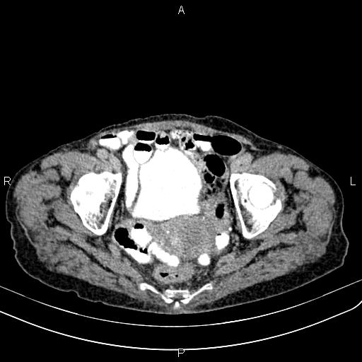 Aortic aneurysm and Lemmel syndrome (Radiopaedia 86499-102554 Axial C+ delayed 70).jpg