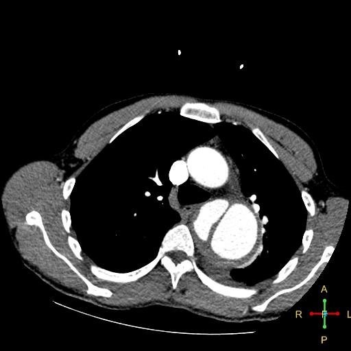 File:Aortic aneurysm and penetrating ulcer (Radiopaedia 23590-23704 A 11).jpg