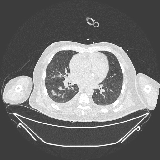 Aortic arch aneurysm (Radiopaedia 84109-99365 Axial lung window 159).jpg