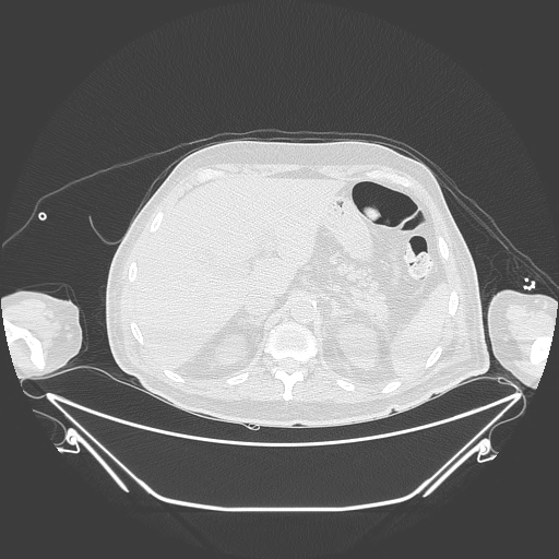 Aortic arch aneurysm (Radiopaedia 84109-99365 Axial lung window 272).jpg