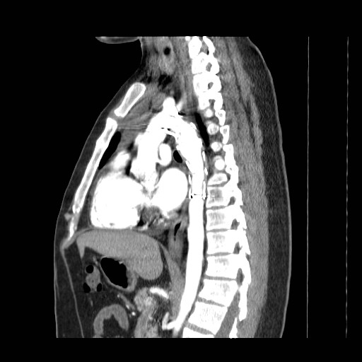File:Aortic arch stent (Radiopaedia 30030-30595 E 10).jpg