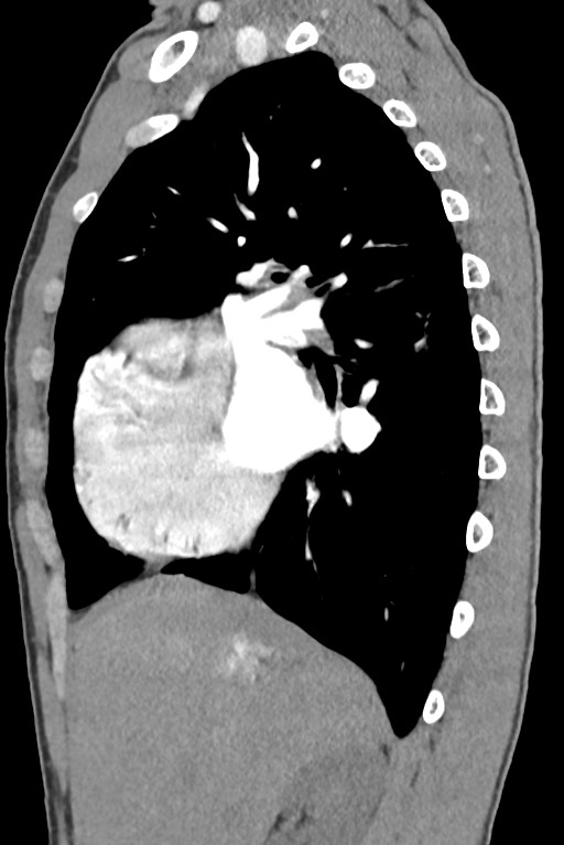 Aortic coarctation with aneurysm (Radiopaedia 74818-85828 B 58).jpg