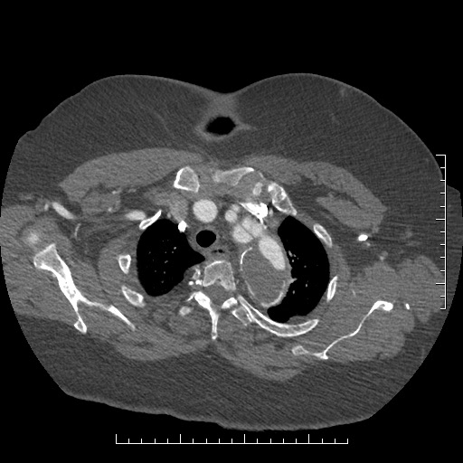 Aortic dissection- Stanford A (Radiopaedia 35729-37268 A 8).jpg