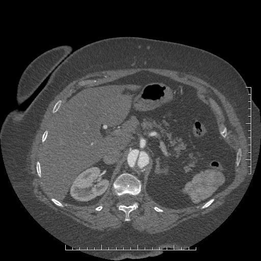 Aortic dissection- Stanford A (Radiopaedia 35729-37268 B 44).jpg