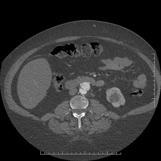 File:Aortic dissection- Stanford A (Radiopaedia 35729-37268 C 15).jpg