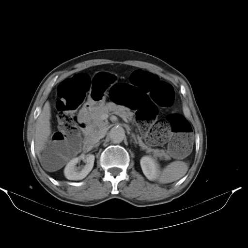 File:Aortic dissection- Stanford type A (Radiopaedia 22085-22085 Axial C+ delayed 18).jpg
