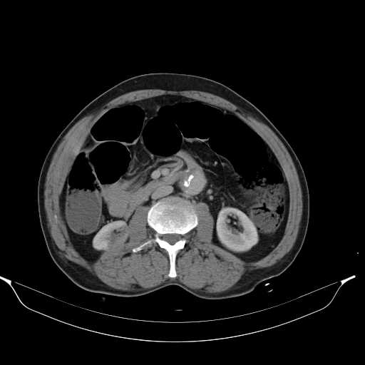 File:Aortic dissection- Stanford type A (Radiopaedia 22085-22085 Axial C+ delayed 25).jpg