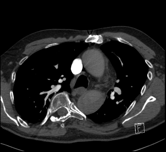 File:Aortic dissection (CTPA) (Radiopaedia 75506-86751 Axial C+ CTPA 52).jpg