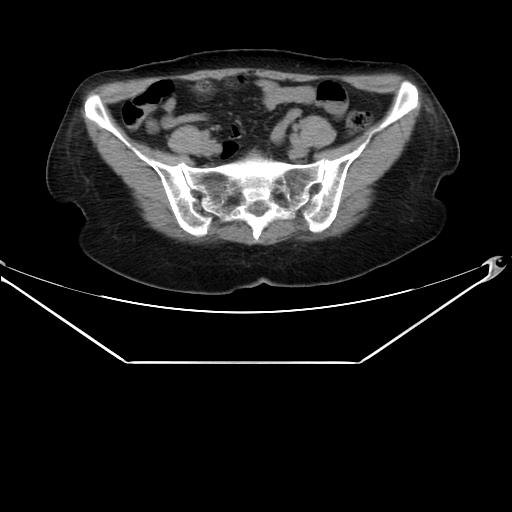 Aortic dissection (Radiopaedia 25350-25604 B 62).jpg