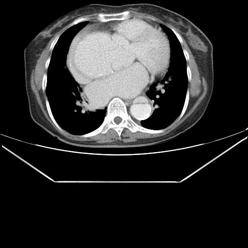 File:Aortic dissection (Radiopaedia 25350-25604 C 30).jpg