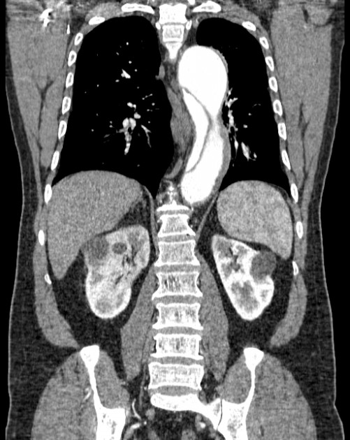 Aortic dissection (Radiopaedia 44411-48061 A 42).jpg