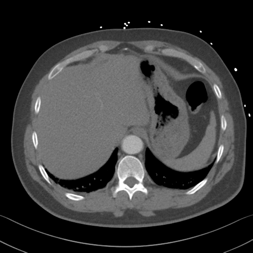 Aortic dissection (Radiopaedia 50763-56234 A 65).png
