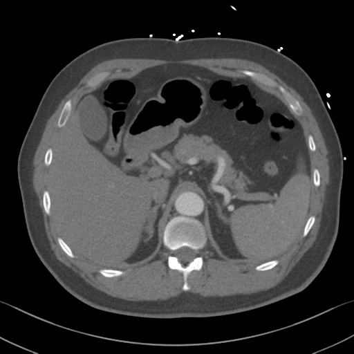 Aortic dissection (Radiopaedia 50763-56234 A 79).png