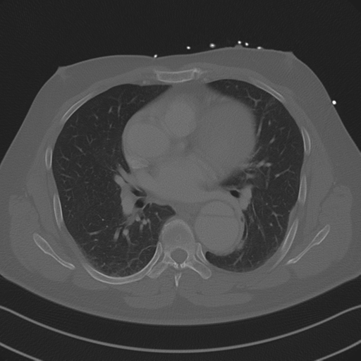 Aortic dissection (Radiopaedia 50763-56234 Axial bone window 56).png