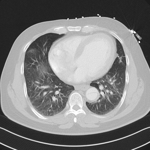 File:Aortic dissection (Radiopaedia 50763-56234 Axial lung window 43).png
