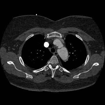 File:Aortic dissection (Radiopaedia 57969-64959 A 83).jpg