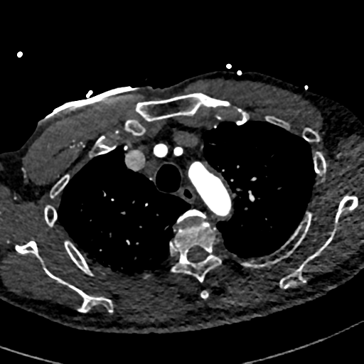 Aortic dissection - DeBakey type II (Radiopaedia 64302-73082 A 21).png