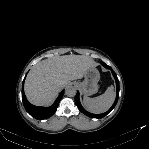 Aortic dissection - Stanford type A (Radiopaedia 83418-98500 Axial non-contrast 40).jpg