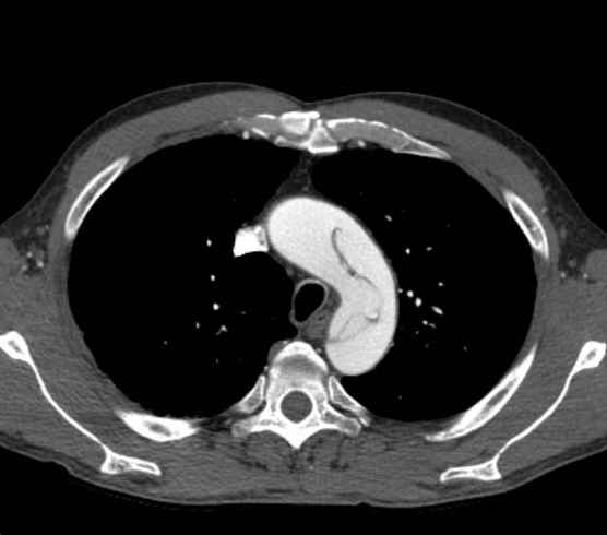 Aortic dissection - Stanford type B (Radiopaedia 73648-84437 A 21).jpg