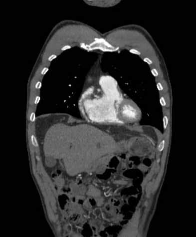 File:Aortic dissection - Stanford type B (Radiopaedia 73648-84437 B 30).jpg