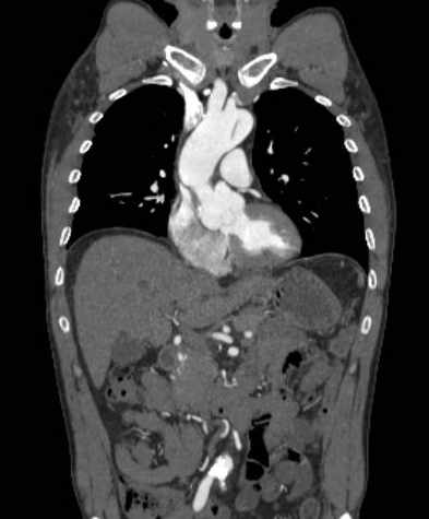 File:Aortic dissection - Stanford type B (Radiopaedia 73648-84437 B 47).jpg