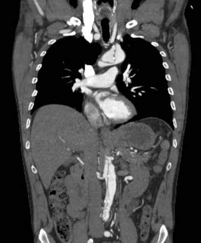 File:Aortic dissection - Stanford type B (Radiopaedia 73648-84437 B 57).jpg