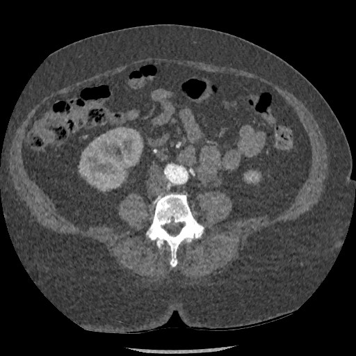 Aortic dissection - Stanford type B (Radiopaedia 88281-104910 A 129).jpg