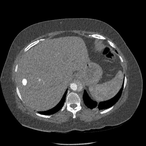 File:Aortic dissection - Stanford type B (Radiopaedia 88281-104910 A 85).jpg