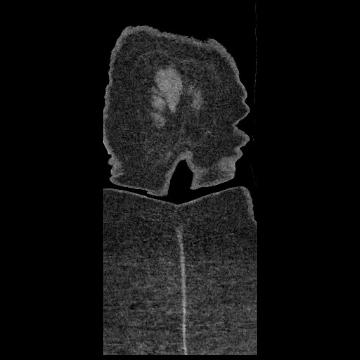 Aortic dissection - Stanford type B (Radiopaedia 88281-104910 B 96).jpg